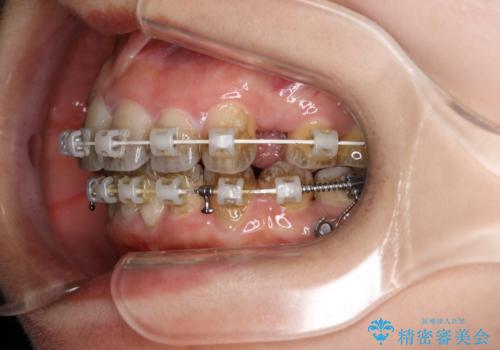 ワイヤー矯正治療中に歯の着色を綺麗にの治療前