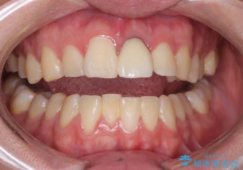 オフィスホワイトニングの治療前