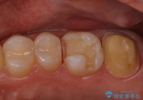 セラミックインレーとクラウンで歯ぐきの腫れを治すの治療中