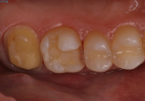 セラミックインレーとクラウンで歯ぐきの腫れを治すの治療中
