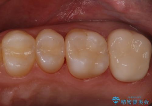 セラミックインレーとクラウンで歯ぐきの腫れを治すの症例 治療後