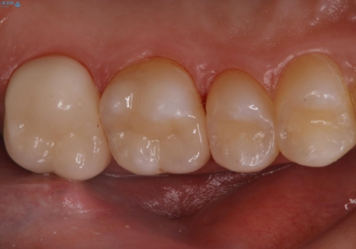 セラミックインレーとクラウンで歯ぐきの腫れを治すの治療後