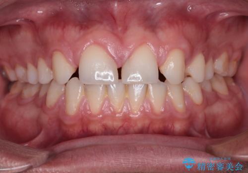 欠損して隙間のある前歯 オールセラミッククラウンで自然な口元にの治療前
