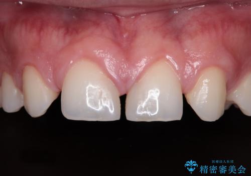 欠損して隙間のある前歯 オールセラミッククラウンで自然な口元にの症例 治療前