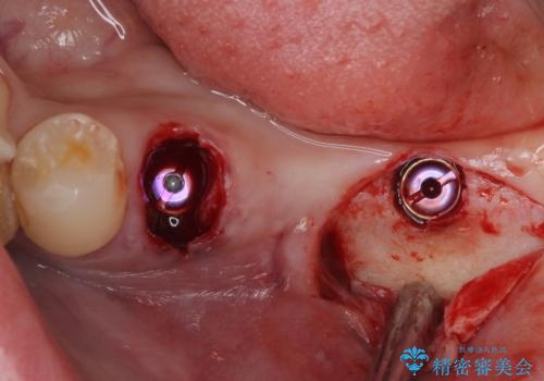 放置していたむし歯 抜歯即時埋入インプラントによる補綴治療の治療中