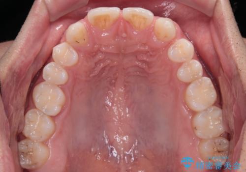 欠損して隙間のある前歯 オールセラミッククラウンで自然な口元にの治療前