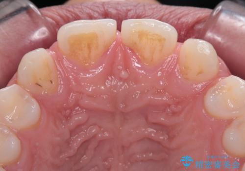 欠損して隙間のある前歯 オールセラミッククラウンで自然な口元にの治療前