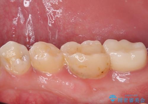 大きく歯が欠けた。 外科処置を行ったセラミック治療の治療後