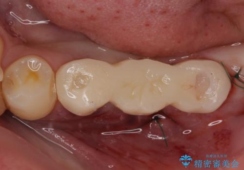 放置していたむし歯 抜歯即時埋入インプラントによる補綴治療の治療後
