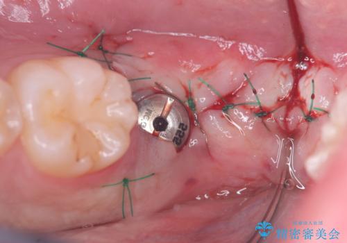 痛くないインプラント治療|1回の手術で終了!|エンドペリオ病変|オールセラミッククラウンの治療中