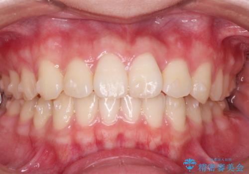 前歯のねじれをマウスピース矯正で治したいの治療中