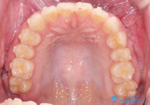 前歯のねじれをマウスピース矯正で治したいの治療中