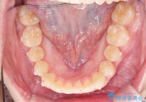 前歯のねじれをマウスピース矯正で治したいの治療中