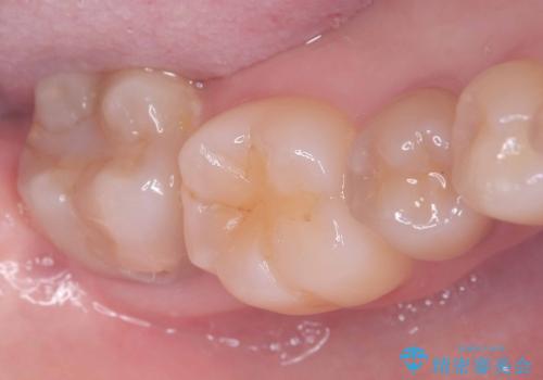 神経を残す治療|VPT|生活歯髄療法|オールセラミッククラウン|神経を残しながらクロスバイトの改善!の症例 治療前