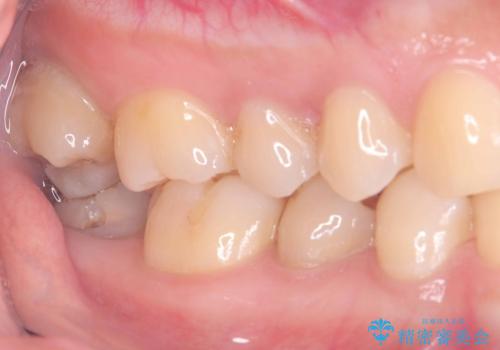 神経を残す治療|VPT|生活歯髄療法|オールセラミッククラウン|神経を残しながらクロスバイトの改善!の治療前