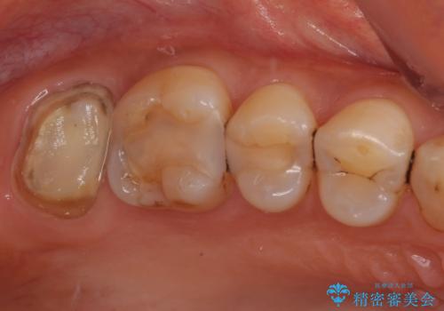 被せものが欠けた オールセラミッククラウンの治療中