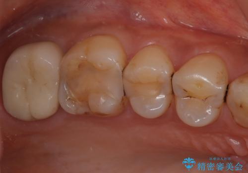 被せものが欠けた オールセラミッククラウンの症例 治療後