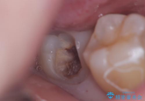 神経を残す治療|VPT|生活歯髄療法|オールセラミッククラウン|神経を残しながらクロスバイトの改善!の治療中