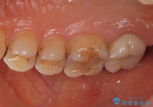 被せものが欠けた オールセラミッククラウンの治療後