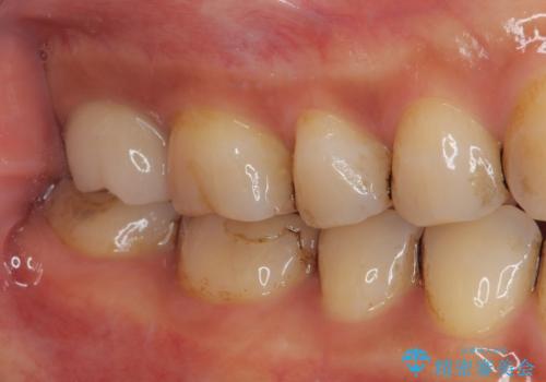 被せものが欠けた オールセラミッククラウンの治療後