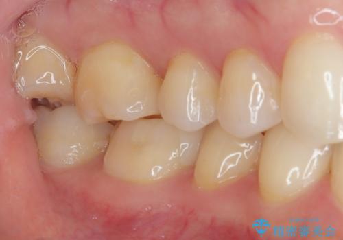 金属の詰め物が目立つのでやり替えたい ハイブリッドインレー修復の治療後