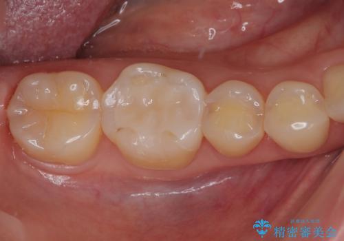 金属の詰め物が目立つのでやり替えたい ハイブリッドインレー修復の症例 治療後