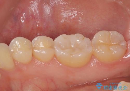 金属の詰め物が目立つのでやり替えたい ハイブリッドインレー修復の治療後