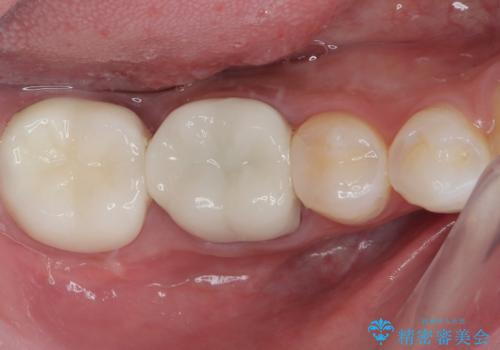 大きな虫歯ができて歯に穴が開いた オールセラミッククラウンの症例 治療後