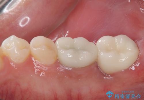 大きな虫歯ができて歯に穴が開いた オールセラミッククラウンの治療後