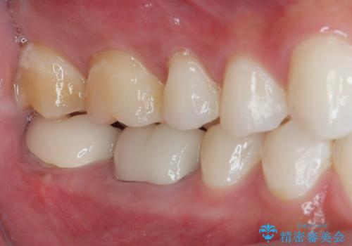 大きな虫歯ができて歯に穴が開いた オールセラミッククラウンの治療後