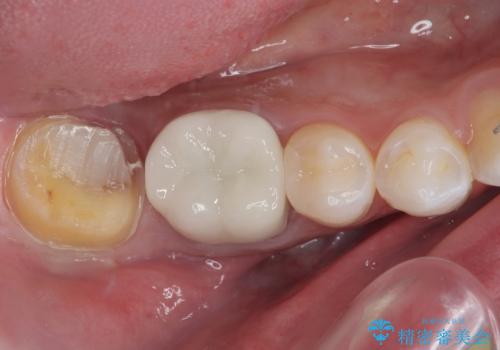 大きな虫歯ができて歯に穴が開いた オールセラミッククラウンの治療中