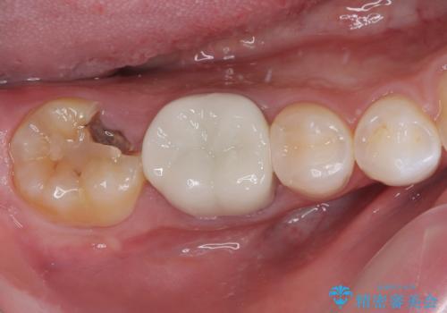 大きな虫歯ができて歯に穴が開いた オールセラミッククラウンの症例 治療前