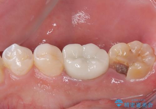 大きな虫歯ができて歯に穴が開いた オールセラミッククラウンの治療前