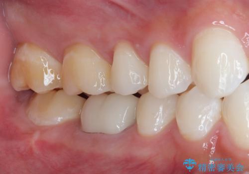 大きな虫歯ができて歯に穴が開いた オールセラミッククラウンの治療前