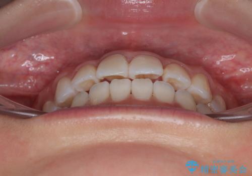 捻れた前歯を楽して改善 ワイヤー装置での非抜歯矯正の治療後