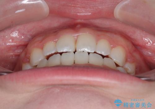【モニター】舌突出癖で隙間が ワイヤー装置での抜歯矯正の治療後