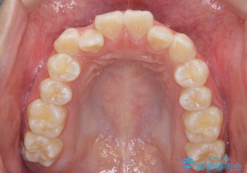 上下すれ違った前歯の矯正治療の治療前