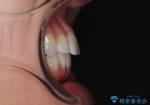 捻れた前歯を楽して改善 ワイヤー装置での非抜歯矯正の治療後