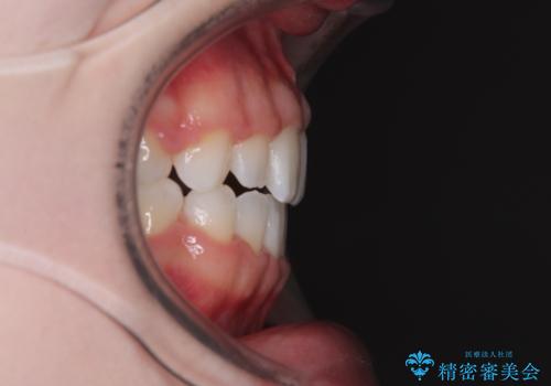 【モニター】舌突出癖で隙間が ワイヤー装置での抜歯矯正の治療後