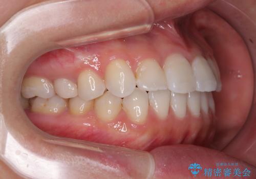 捻れた前歯を楽して改善 ワイヤー装置での非抜歯矯正の治療後