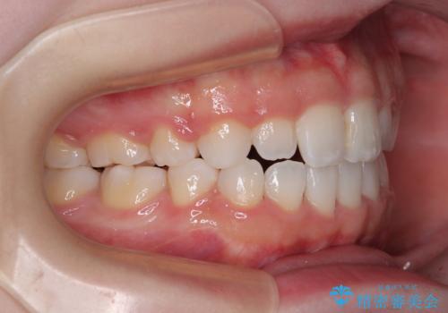 【モニター】舌突出癖で隙間が ワイヤー装置での抜歯矯正の治療後