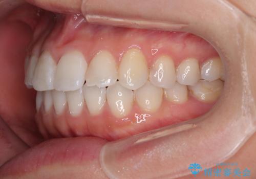 捻れた前歯を楽して改善 ワイヤー装置での非抜歯矯正の治療後