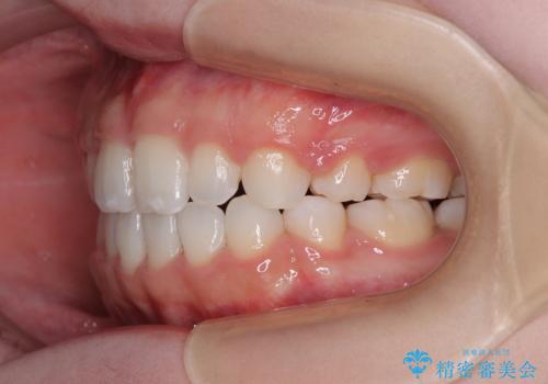 【モニター】舌突出癖で隙間が ワイヤー装置での抜歯矯正の治療後