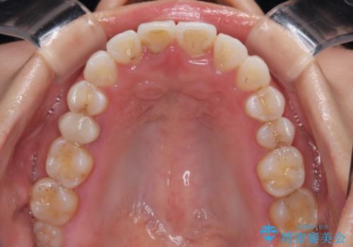 捻れた前歯を楽して改善 ワイヤー装置での非抜歯矯正の治療後