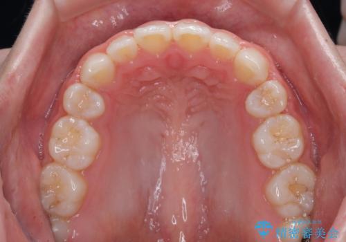 【モニター】舌突出癖で隙間が ワイヤー装置での抜歯矯正の治療後