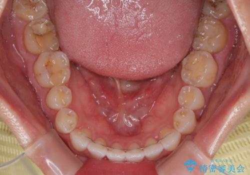 捻れた前歯を楽して改善 ワイヤー装置での非抜歯矯正の治療後