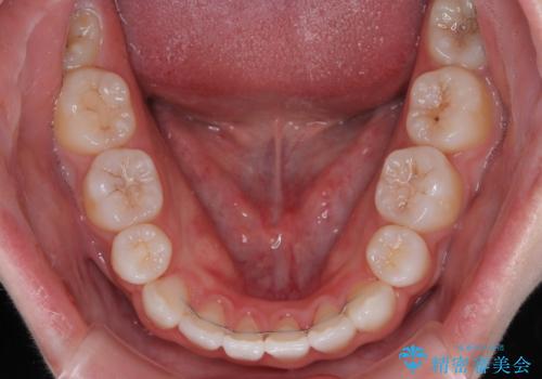 【モニター】舌突出癖で隙間が ワイヤー装置での抜歯矯正の治療後