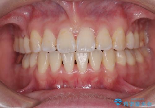 【モニター】口が閉じられない ワイヤー装置での抜歯矯正の症例 治療後