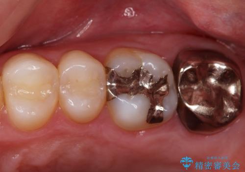 セラミックインレーとクラウンで歯ぐきの腫れを治すの治療前