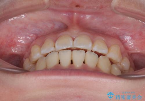 【モニター】口が閉じられない ワイヤー装置での抜歯矯正の治療後